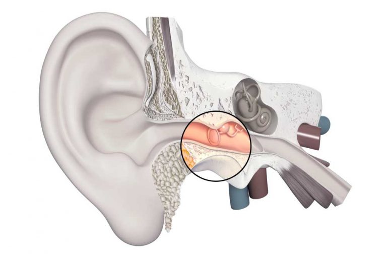202103MondialUditoCentroAcusticoipoacusiatrasmissivaLombardia